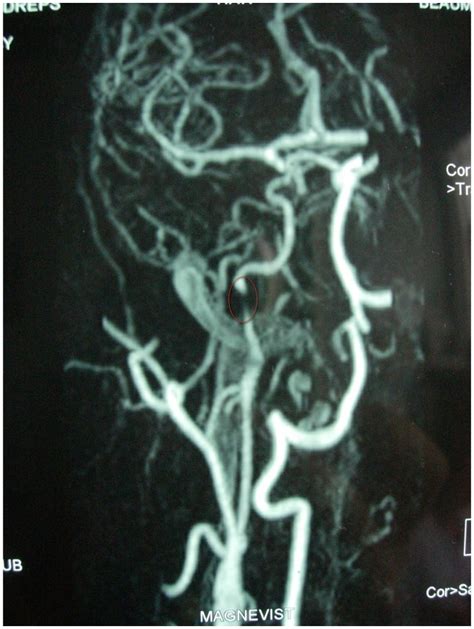 A magnetic resonance angiography (MRA) of patient 1, which reveals ...