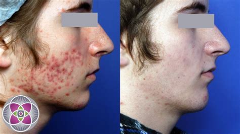 Acne Laser Skin Treatment - Acne Face Scars