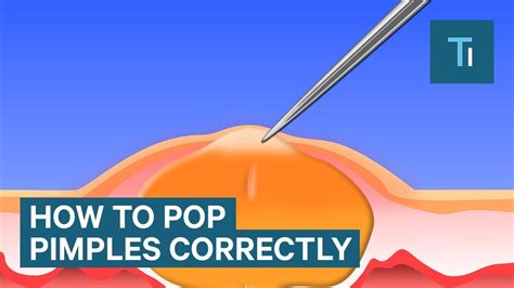 Blind Pimple Diagram - exatin.info