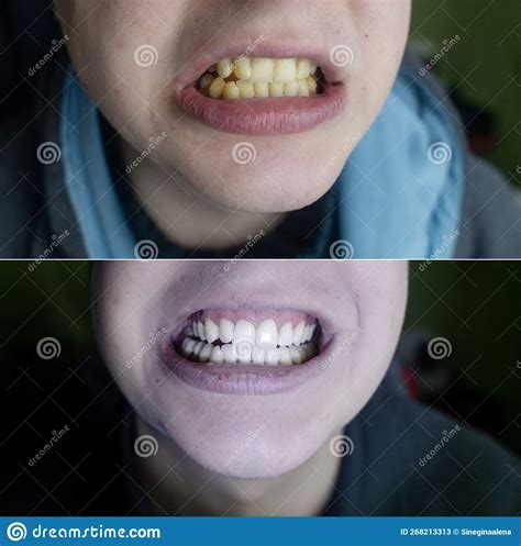 Tartar Removal. before and after the Procedure for Cleaning the Tooth ...