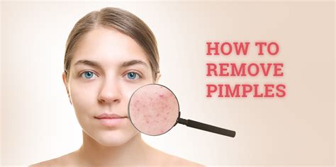 Neat Tips About How To Cure Pimples - Petertrade29