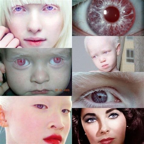 Albino with Violet Eyes