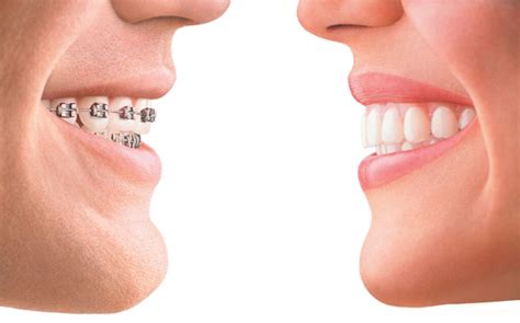 Orthodontics Australia | What is an ideal bite?