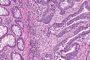 Adenocarcinoma Colon Histology