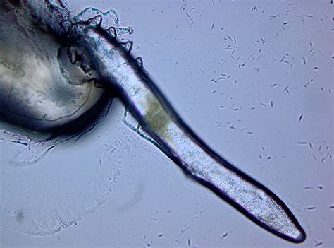 The role of "Demodex" mites with dry eyes - Athens Eye Hospital