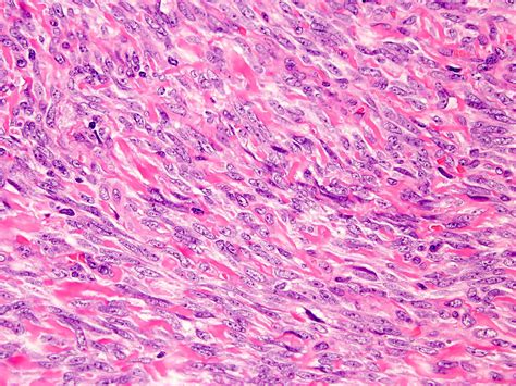 Synovial Sarcoma Histology