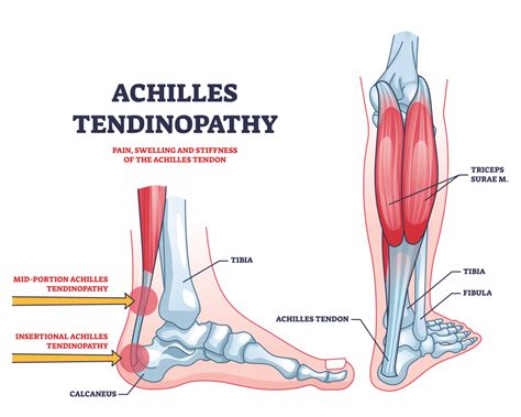 What is Achilles Tendonitis and Why Does It Hurt?: Eugene Stautberg, MD ...