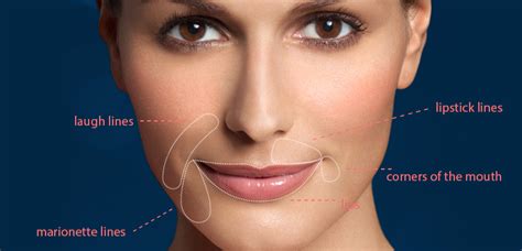 Restylane® Silk for Wrinkles and Lines around the Mouth.