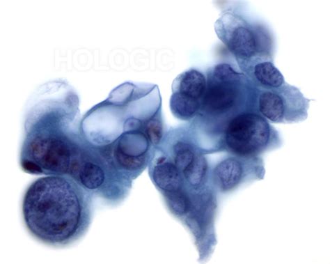 adenocarcinoma pancreas cytology