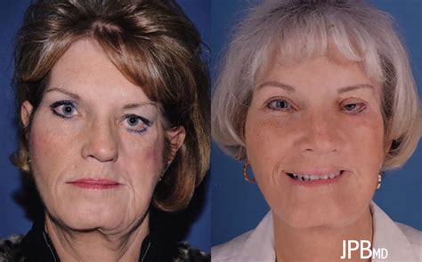 Craniofacial Surgery Before & After Photos | James P. Bradley, MD