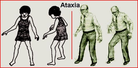 Ataxia; Coordination Impairment; Dyssynergia; Incoordination