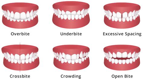 Common Dental Bite Problems | Mint Hill Dentistry | Dentist Charlotte NC