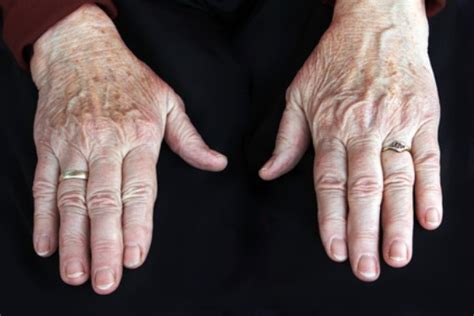 First Symptoms of Cancer Appear on the Hands