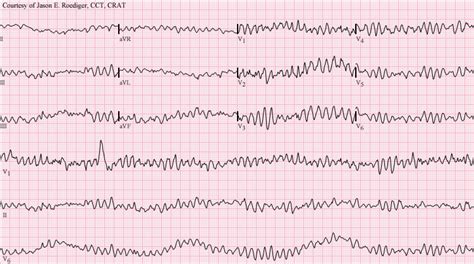 Ventricular Fibrillation ECG 2 | LearntheHeart.com