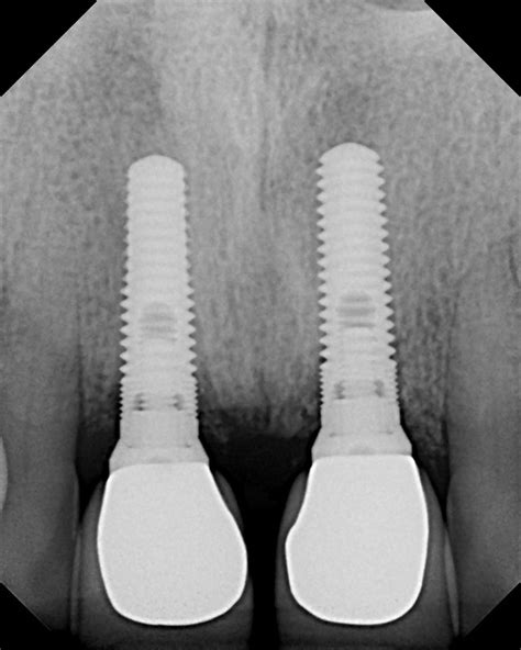 Dental Implant X-rays