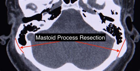 The Surgical Technique for Mastoid Process Skull Reduction - Explore ...