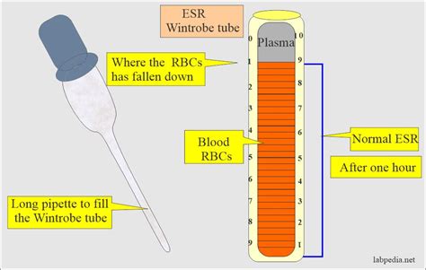 Erythrocyte sedimentation rate (ESR) solution and procedure