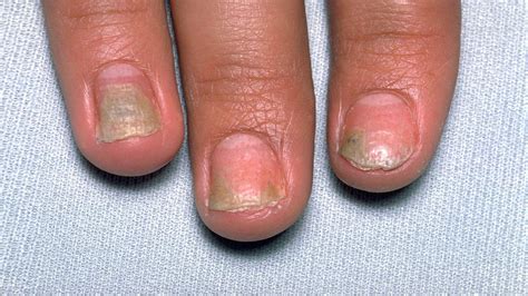 How Psoriatic Arthritis Can Damage Your Nails | Everyday Health