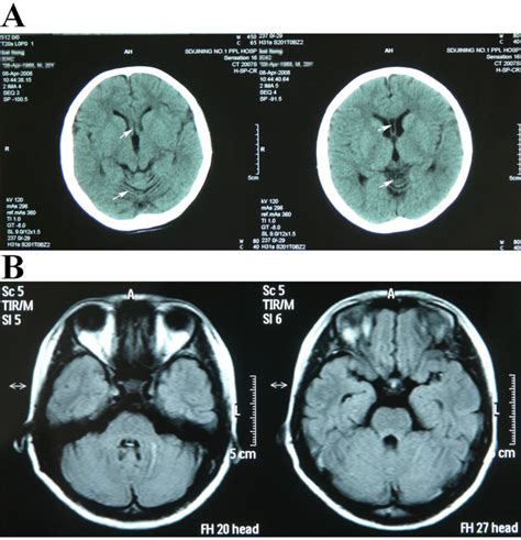 The CT scan and MRI scan results. A: CT scan of the proband’s brain ...