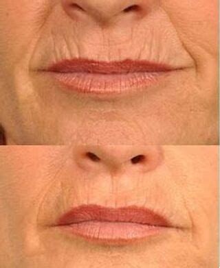 Lip Lines - PREMIER DERM MD | TREATING ACNE & SCARRING, WRINKLES, DARK ...