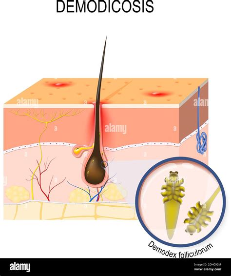 demodicosis. face mites. Demodex folliculorum is a type of skin mite ...