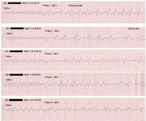 V Fib Vs V Tach Strips - vayp-por