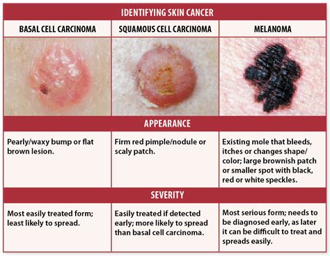 Skin Cancer Signs? Self-Checks May Help You Avoid Deadly Recurrence ...