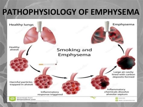 Emphysema