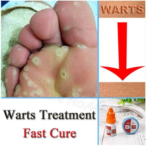 Aliexpress.com : Buy Chinese Medicine Treatment Foot Corn Removal Cream ...