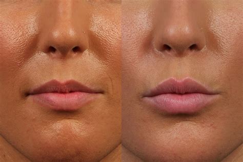 Avoid Lip Filler Mistakes | Dr. Brett Kotlus, Cosmetic Oculoplastic ...