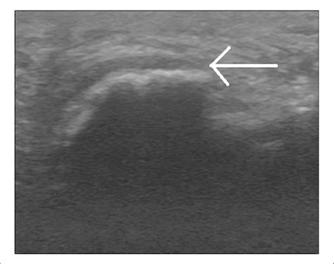 C. Ultrasound view of the plantar fascia, which is marked with the ...