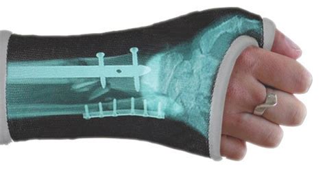 Custom Casts Let You Pimp Your Broken Bones | WIRED