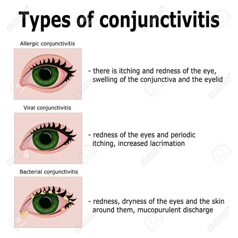 Midtown Optometry - Conjuctivitis (Pink Eye) —Diagnosis And Treatment