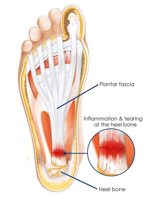 Plantar Fasciitis - Physio Professionals