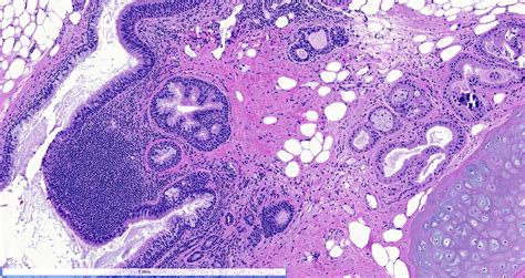 Teratoma Histology