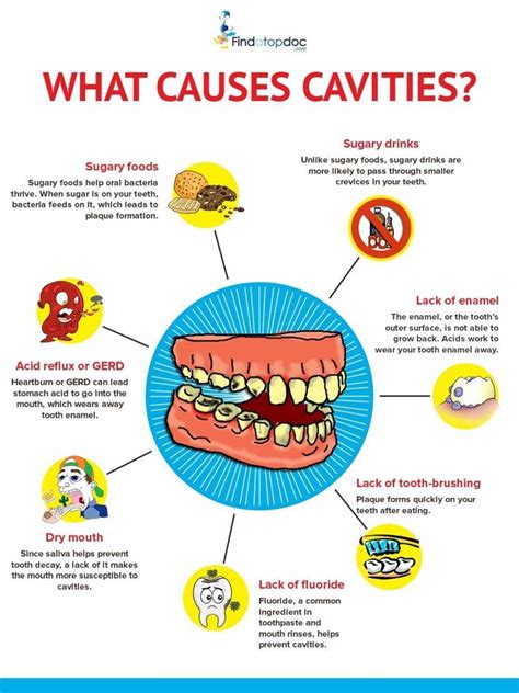 Cavities/ Tooth Decay: Symptoms, Causes, Treatment, and Diagnosis ...