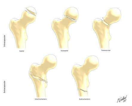 Compound Fracture Left Femur - Foto Kolekcija