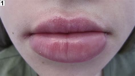 Upper Lip Swelling At Night | Sitelip.org