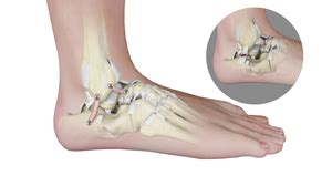 Foot Reconstruction Surgeon Oxnard, Camarillo, CA | Reconstructive ...