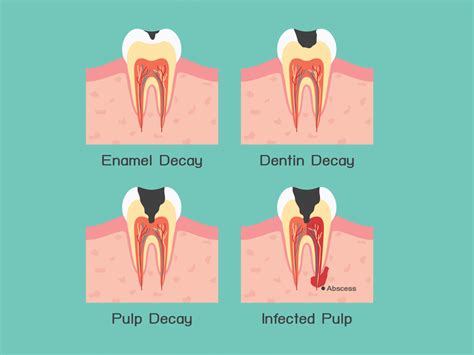 How to prevent tooth decay?