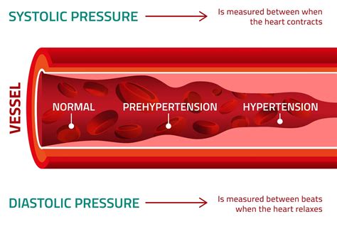 Causes Of High Diastolic Blood Pressure Best Sale | www.aikicai.org