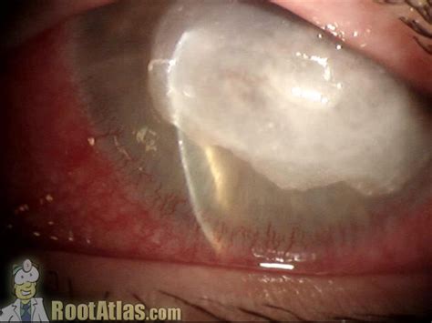 Perforated Corneal Ulcer (Photo) - TimRoot.com