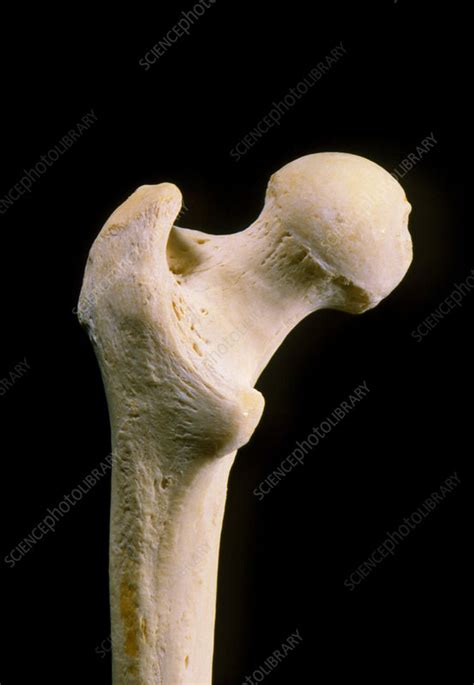 Head of human femur (thigh bone) - Stock Image - P116/0101 - Science ...