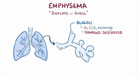 Emphysema: What Is It, Difference From COPD, and More | Osmosis