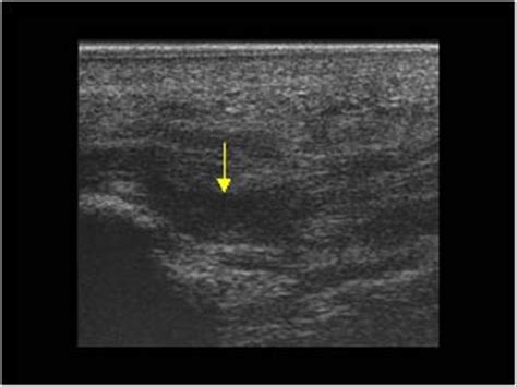 Musculoskeletal Joints and Tendons | 6.8 Foot : Case 6.8.11 Plantar ...