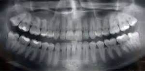 Why a Panorex X-ray for Wisdom Teeth Extractions? | Why a Panorex X-ray ...