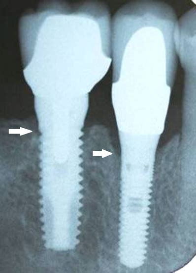 Dental Implant Xray