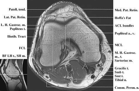 Knee Muscle Anatomy Mri Das Knie Mrt Anatomieatlas In | The Best Porn ...