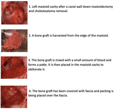 Mastoid Surgery Images | Ear Associates & Rehabilitation Services of ...