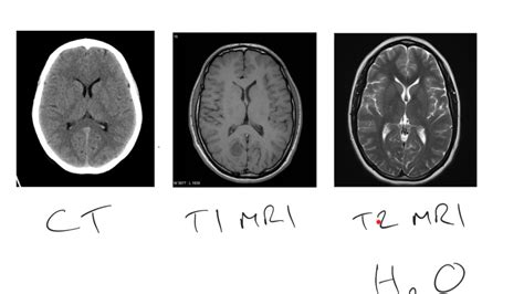 Mri Vs Ct Brain